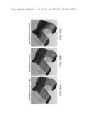 PATIENT-ADAPTED AND IMPROVED ARTICULAR IMPLANTS, DESIGNS AND RELATED GUIDE     TOOLS diagram and image