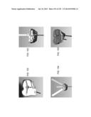 PATIENT-ADAPTED AND IMPROVED ARTICULAR IMPLANTS, DESIGNS AND RELATED GUIDE     TOOLS diagram and image