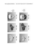 PATIENT-ADAPTED AND IMPROVED ARTICULAR IMPLANTS, DESIGNS AND RELATED GUIDE     TOOLS diagram and image