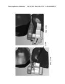 PATIENT-ADAPTED AND IMPROVED ARTICULAR IMPLANTS, DESIGNS AND RELATED GUIDE     TOOLS diagram and image