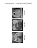 PATIENT-ADAPTED AND IMPROVED ARTICULAR IMPLANTS, DESIGNS AND RELATED GUIDE     TOOLS diagram and image