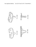 PATIENT-ADAPTED AND IMPROVED ARTICULAR IMPLANTS, DESIGNS AND RELATED GUIDE     TOOLS diagram and image