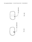 PATIENT-ADAPTED AND IMPROVED ARTICULAR IMPLANTS, DESIGNS AND RELATED GUIDE     TOOLS diagram and image