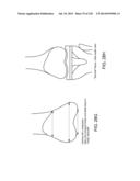 PATIENT-ADAPTED AND IMPROVED ARTICULAR IMPLANTS, DESIGNS AND RELATED GUIDE     TOOLS diagram and image