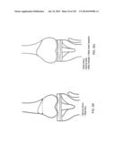 PATIENT-ADAPTED AND IMPROVED ARTICULAR IMPLANTS, DESIGNS AND RELATED GUIDE     TOOLS diagram and image