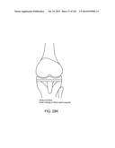 PATIENT-ADAPTED AND IMPROVED ARTICULAR IMPLANTS, DESIGNS AND RELATED GUIDE     TOOLS diagram and image