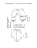 PATIENT-ADAPTED AND IMPROVED ARTICULAR IMPLANTS, DESIGNS AND RELATED GUIDE     TOOLS diagram and image