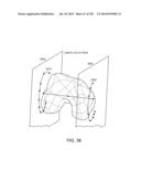 PATIENT-ADAPTED AND IMPROVED ARTICULAR IMPLANTS, DESIGNS AND RELATED GUIDE     TOOLS diagram and image