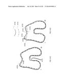 PATIENT-ADAPTED AND IMPROVED ARTICULAR IMPLANTS, DESIGNS AND RELATED GUIDE     TOOLS diagram and image