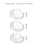 PATIENT-ADAPTED AND IMPROVED ARTICULAR IMPLANTS, DESIGNS AND RELATED GUIDE     TOOLS diagram and image