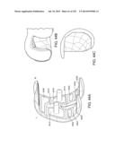 PATIENT-ADAPTED AND IMPROVED ARTICULAR IMPLANTS, DESIGNS AND RELATED GUIDE     TOOLS diagram and image