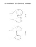 PATIENT-ADAPTED AND IMPROVED ARTICULAR IMPLANTS, DESIGNS AND RELATED GUIDE     TOOLS diagram and image