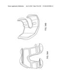 PATIENT-ADAPTED AND IMPROVED ARTICULAR IMPLANTS, DESIGNS AND RELATED GUIDE     TOOLS diagram and image