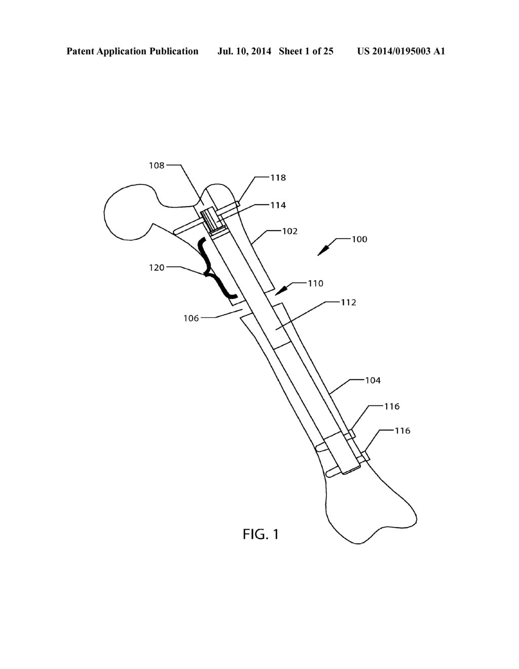 SYSTEM AND METHOD FOR ALTERING ROTATIONAL ALIGNMENT OF BONE SECTIONS - diagram, schematic, and image 02