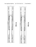 Liner Hanger/Packer Apparatus with Pressure Balance Feature on Anchor     Slips to Facilitate Removal diagram and image