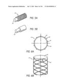 MINIMALLY INVASIVE BREAST LIFT METHOD WITH A SUPERIOR TISSUE SUPPORT AND     AN INFERIOR ANCHOR diagram and image