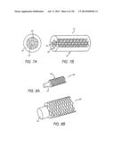 MINIMALLY INVASIVE BREAST LIFT METHOD WITH A SUPERIOR TISSUE SUPPORT AND     AN INFERIOR ANCHOR diagram and image