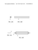 MINIMALLY INVASIVE BREAST LIFT METHOD WITH A SUPERIOR TISSUE SUPPORT AND     AN INFERIOR ANCHOR diagram and image