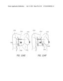 MINIMALLY INVASIVE BREAST LIFT METHOD WITH A SUPERIOR TISSUE SUPPORT AND     AN INFERIOR ANCHOR diagram and image