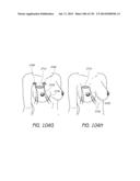 MINIMALLY INVASIVE BREAST LIFT METHOD WITH A SUPERIOR TISSUE SUPPORT AND     AN INFERIOR ANCHOR diagram and image