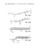 MINIMALLY INVASIVE BREAST LIFT METHOD WITH A SUPERIOR TISSUE SUPPORT AND     AN INFERIOR ANCHOR diagram and image