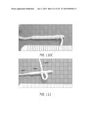 MINIMALLY INVASIVE BREAST LIFT METHOD WITH A SUPERIOR TISSUE SUPPORT AND     AN INFERIOR ANCHOR diagram and image