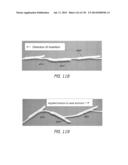 MINIMALLY INVASIVE BREAST LIFT METHOD WITH A SUPERIOR TISSUE SUPPORT AND     AN INFERIOR ANCHOR diagram and image