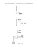 MINIMALLY INVASIVE BREAST LIFT METHOD WITH A SUPERIOR TISSUE SUPPORT AND     AN INFERIOR ANCHOR diagram and image