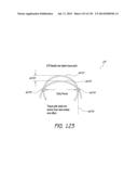 MINIMALLY INVASIVE BREAST LIFT METHOD WITH A SUPERIOR TISSUE SUPPORT AND     AN INFERIOR ANCHOR diagram and image