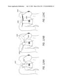 MINIMALLY INVASIVE BREAST LIFT METHOD WITH A SUPERIOR TISSUE SUPPORT AND     AN INFERIOR ANCHOR diagram and image