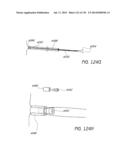 MINIMALLY INVASIVE BREAST LIFT METHOD WITH A SUPERIOR TISSUE SUPPORT AND     AN INFERIOR ANCHOR diagram and image