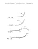 MINIMALLY INVASIVE BREAST LIFT METHOD WITH A SUPERIOR TISSUE SUPPORT AND     AN INFERIOR ANCHOR diagram and image