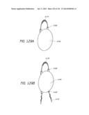 MINIMALLY INVASIVE BREAST LIFT METHOD WITH A SUPERIOR TISSUE SUPPORT AND     AN INFERIOR ANCHOR diagram and image