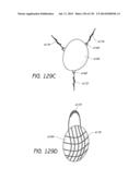 MINIMALLY INVASIVE BREAST LIFT METHOD WITH A SUPERIOR TISSUE SUPPORT AND     AN INFERIOR ANCHOR diagram and image