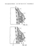 MINIMALLY INVASIVE BREAST LIFT METHOD WITH A SUPERIOR TISSUE SUPPORT AND     AN INFERIOR ANCHOR diagram and image