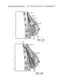 MINIMALLY INVASIVE BREAST LIFT METHOD WITH A SUPERIOR TISSUE SUPPORT AND     AN INFERIOR ANCHOR diagram and image