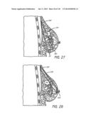 MINIMALLY INVASIVE BREAST LIFT METHOD WITH A SUPERIOR TISSUE SUPPORT AND     AN INFERIOR ANCHOR diagram and image