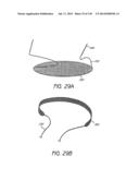 MINIMALLY INVASIVE BREAST LIFT METHOD WITH A SUPERIOR TISSUE SUPPORT AND     AN INFERIOR ANCHOR diagram and image