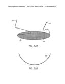 MINIMALLY INVASIVE BREAST LIFT METHOD WITH A SUPERIOR TISSUE SUPPORT AND     AN INFERIOR ANCHOR diagram and image