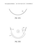 MINIMALLY INVASIVE BREAST LIFT METHOD WITH A SUPERIOR TISSUE SUPPORT AND     AN INFERIOR ANCHOR diagram and image