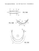 MINIMALLY INVASIVE BREAST LIFT METHOD WITH A SUPERIOR TISSUE SUPPORT AND     AN INFERIOR ANCHOR diagram and image