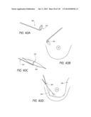 MINIMALLY INVASIVE BREAST LIFT METHOD WITH A SUPERIOR TISSUE SUPPORT AND     AN INFERIOR ANCHOR diagram and image