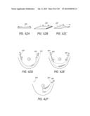 MINIMALLY INVASIVE BREAST LIFT METHOD WITH A SUPERIOR TISSUE SUPPORT AND     AN INFERIOR ANCHOR diagram and image