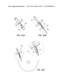 MINIMALLY INVASIVE BREAST LIFT METHOD WITH A SUPERIOR TISSUE SUPPORT AND     AN INFERIOR ANCHOR diagram and image