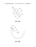 MINIMALLY INVASIVE BREAST LIFT METHOD WITH A SUPERIOR TISSUE SUPPORT AND     AN INFERIOR ANCHOR diagram and image