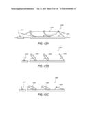 MINIMALLY INVASIVE BREAST LIFT METHOD WITH A SUPERIOR TISSUE SUPPORT AND     AN INFERIOR ANCHOR diagram and image