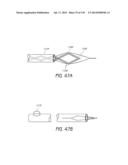 MINIMALLY INVASIVE BREAST LIFT METHOD WITH A SUPERIOR TISSUE SUPPORT AND     AN INFERIOR ANCHOR diagram and image