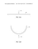 MINIMALLY INVASIVE BREAST LIFT METHOD WITH A SUPERIOR TISSUE SUPPORT AND     AN INFERIOR ANCHOR diagram and image