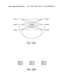 MINIMALLY INVASIVE BREAST LIFT METHOD WITH A SUPERIOR TISSUE SUPPORT AND     AN INFERIOR ANCHOR diagram and image