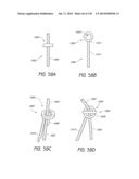 MINIMALLY INVASIVE BREAST LIFT METHOD WITH A SUPERIOR TISSUE SUPPORT AND     AN INFERIOR ANCHOR diagram and image